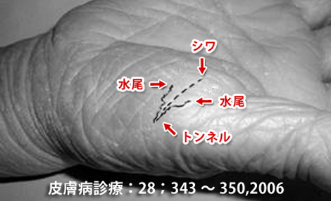 疥癬トンネル(線状皮疹の後方に水尾型の鱗屑を伴い、全体としてY字型に見える皮疹)