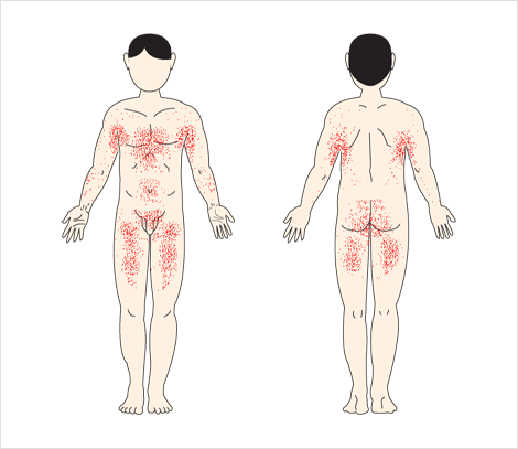 丘疹の好発部位