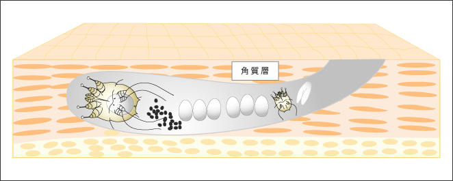 疥癬トンネルの模式図