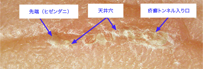 疥癬トンネルの形態