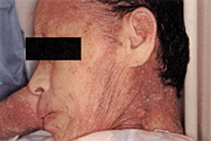 角化型疥癬の顔