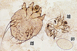 ヒゼンダニ（写真提供：九段坂病院 皮膚科 大滝倫子先生）