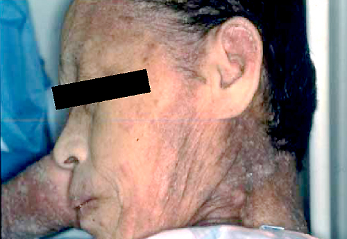 角化型疥癬の顔