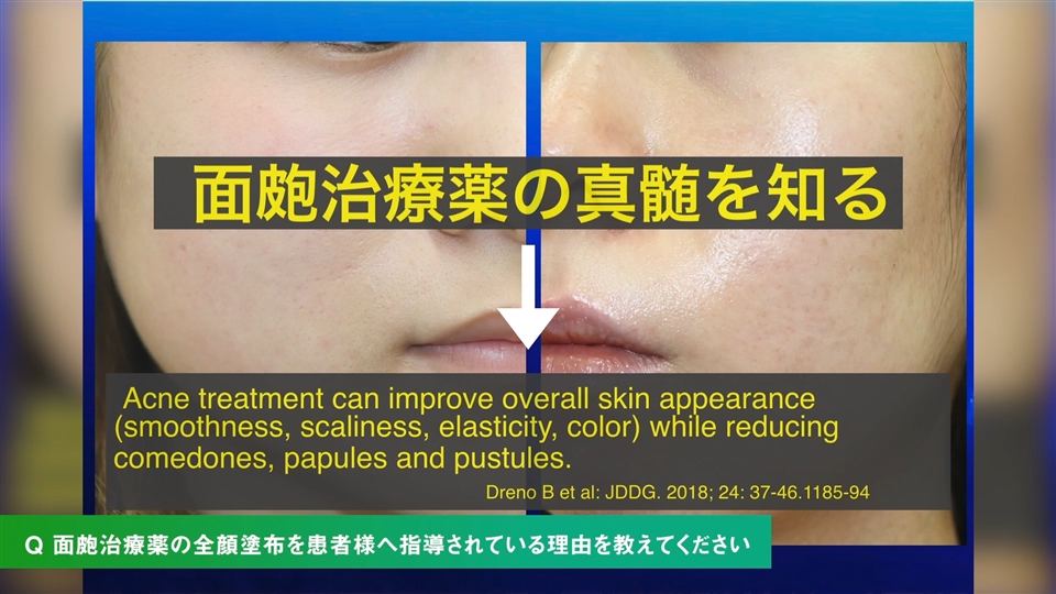 面皰治療薬の全顔塗布の重要性