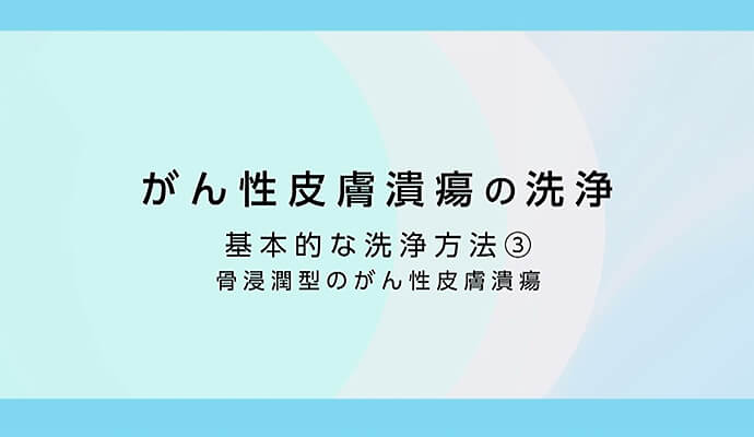 潰瘍からの出血への対応