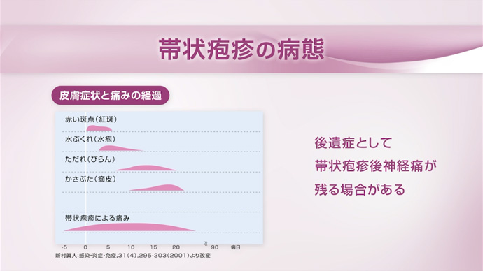 帯状疱疹の病態