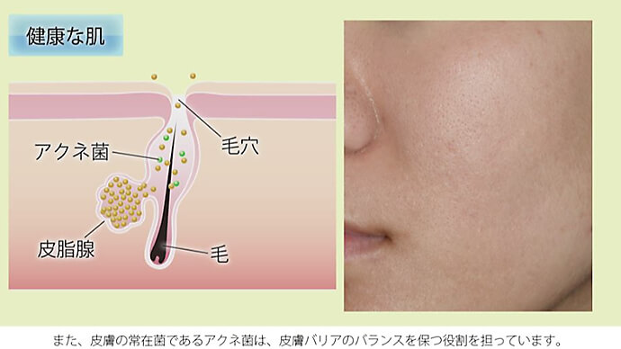 ニキビができるメカニズム ～毛穴の奥をのぞいてみよう～