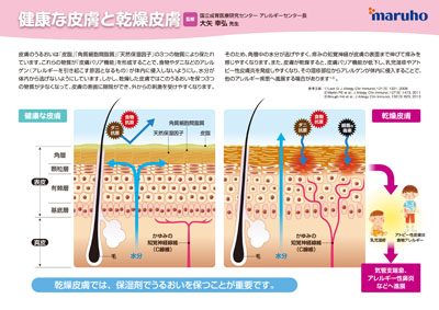 （下敷き）アレルギーマーチ患者指導用