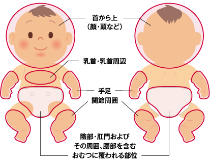 すぐにでも受診していただきたい目安 乳児血管腫 いちご状血管腫 の治療 患者さん 一般の皆さま マルホ株式会社