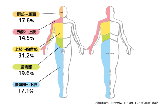 尻 ヘルペス お 帯状疱疹でおしりが痛む時の対処法は？