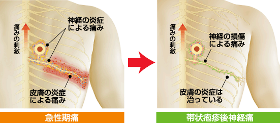 帯状 疱疹 前兆