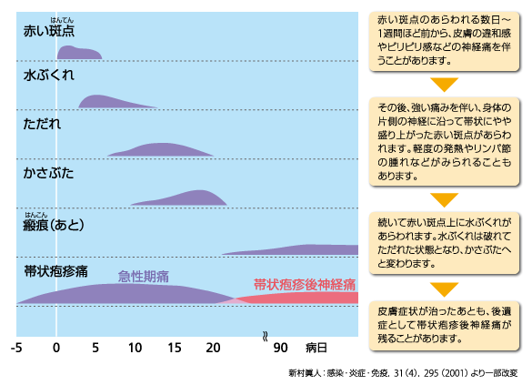 帯状 疱疹 治る まで