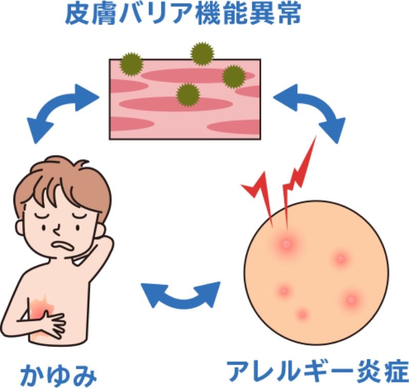 かゆみのサイクル