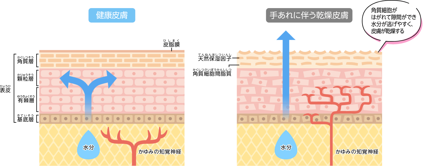 健康皮膚と手あれに伴う乾燥皮膚