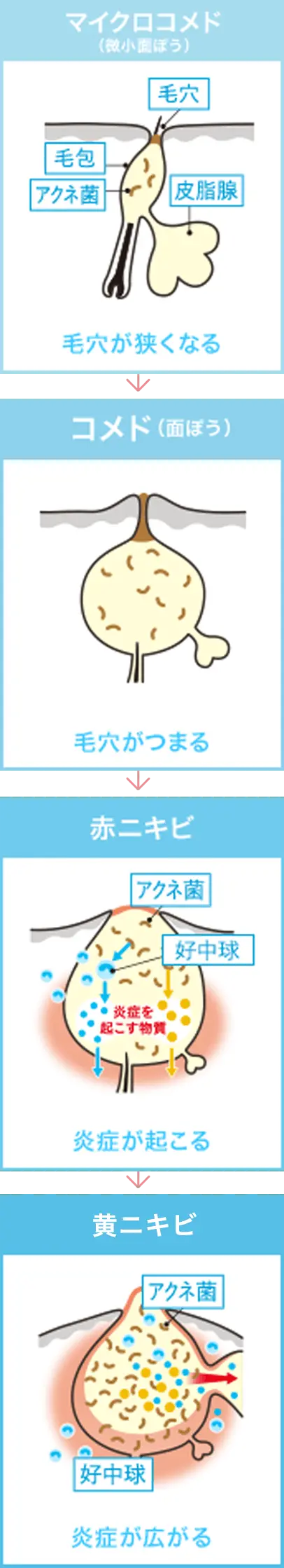マイクロコメド(微小面ぽう) 毛穴が狭くなる → コメド(面ぽう) 毛穴がつまる → 赤ニキビ 炎症が起こる → 化膿したニキビ 炎症が広がる