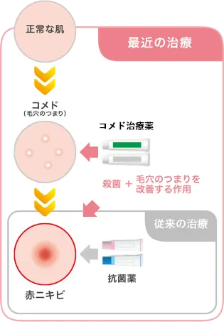 抗菌薬からコメド治療薬への移り変わり