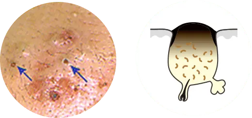 黒ニキビの画像と毛穴の断面図
