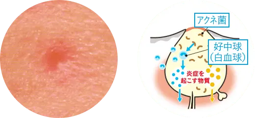 赤ニキビの画像と毛穴の断面図