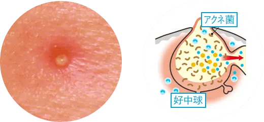 黄ニキビの画像と毛穴の断面図