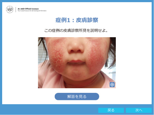 小児のアトピー性皮膚炎