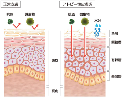 アトピー:正常皮膚との比較(バリア)
