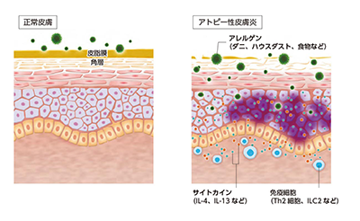 アトピー:正常皮膚との比較(免疫系)