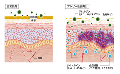アトピー:正常皮膚との比較(神経系)