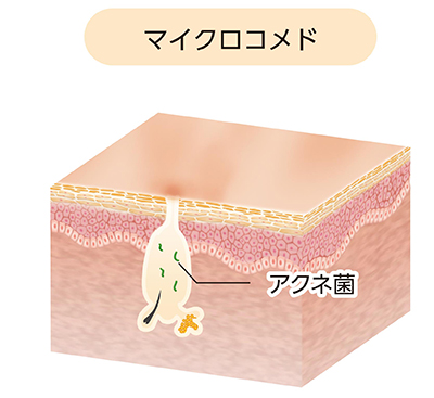 ざ瘡:微小面皰(マイクロコメド)