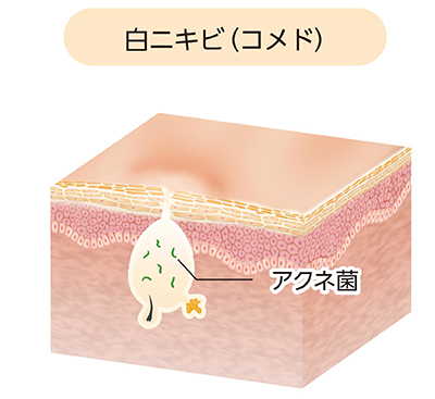ざ瘡:閉鎖面皰(白ニキビ)