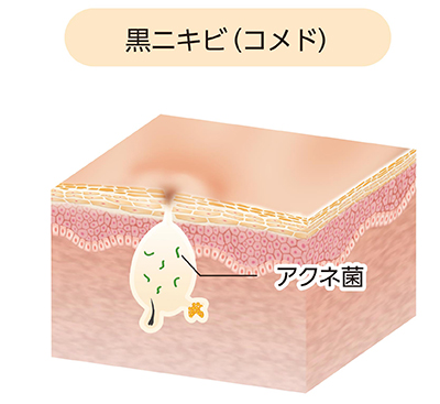 ざ瘡:開放面皰(黒ニキビ)