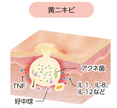 ざ瘡:膿疱(黄ニキビ)