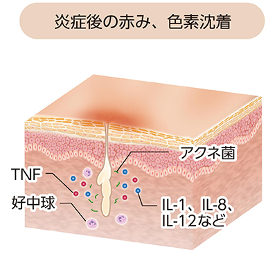 ざ瘡:炎症後紅斑(炎症後紅斑・色素沈着)