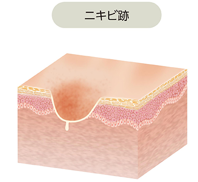 ざ瘡:萎縮性瘢痕(ニキビ跡)
