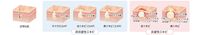 ざ瘡:炎症性ざ瘡と非炎症性ざ瘡の比較