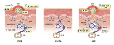 単純ヘルペスウイルス:初感染~回帰感染