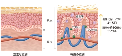 正常皮膚と乾癬皮膚