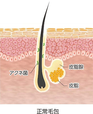 ざ瘡:正常毛包(平面図)