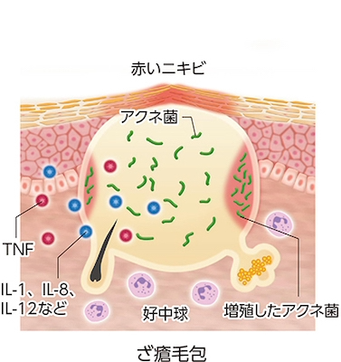 ざ瘡:ざ瘡毛包(平面図)