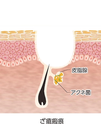 ざ瘡:ざ瘡瘢痕(平面図)