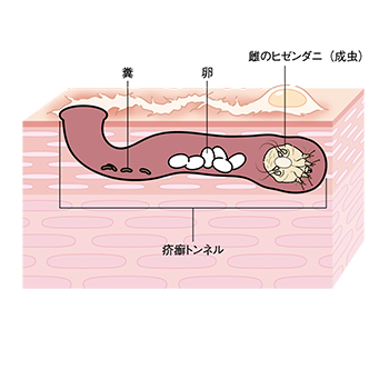 疥癬:疥癬トンネルとヒゼンダニ