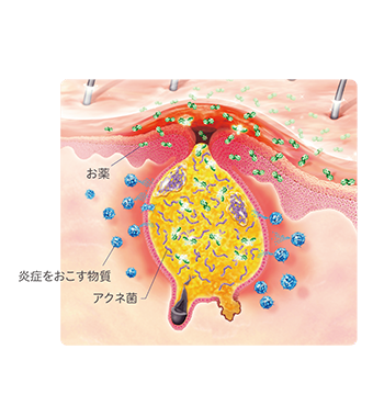 ざ瘡(簡易版):ざ瘡治療薬のはたらき