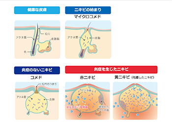 ざ瘡症状を説明するスライド