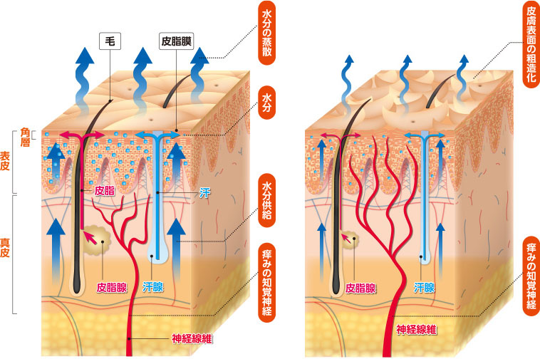 痒みが起きる機序:正常な皮膚と透析患者の皮膚