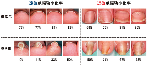 図2：  健常爪と巻き爪の代表的な臨床写真と爪幅狭小化率