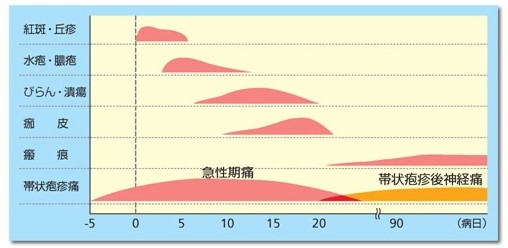 帯状疱疹における皮疹と痛みの推移