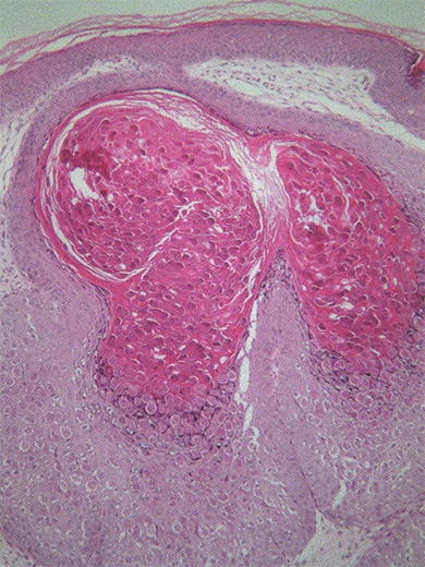 図2：伝染性軟属腫の病理組織像
