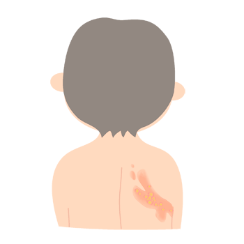 帯状疱疹（背中）