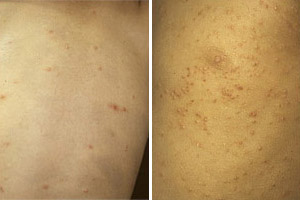 小児の体幹にみられた伝染性軟属腫 左:散発例 右:播種状の多発例