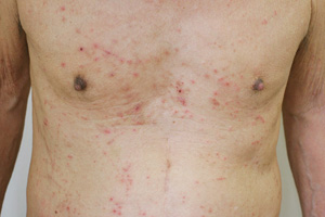 紅斑性小丘疹の症例写真