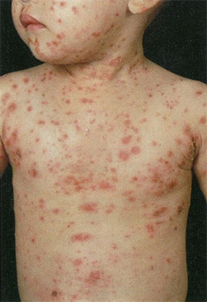 水疱性膿痂疹の臨床症状
